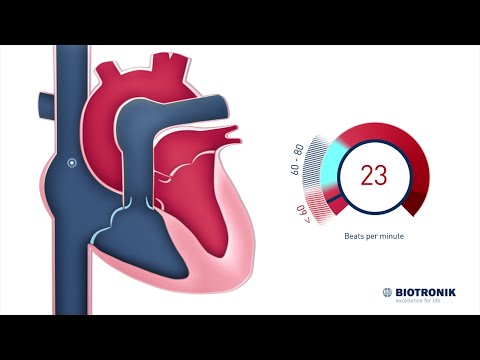 What is a normal vs. a slow heart rate? (Medical Animation)