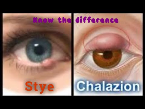 cum afectează chalazion viziunea recomandări după operația de vedere laser