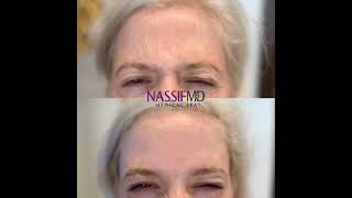 Jennifer Allen Shows Off Her Botox Results!