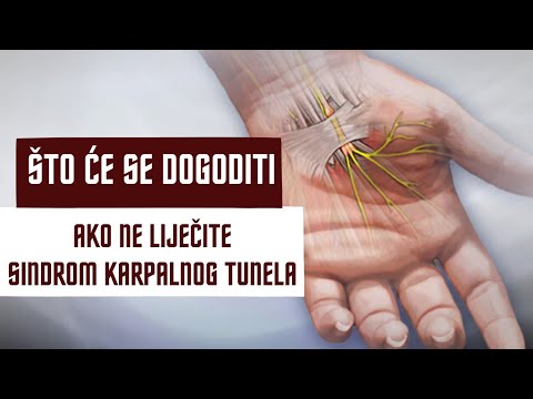 Najgore faze sindroma karpalnog tunela i kako ih spriječiti?