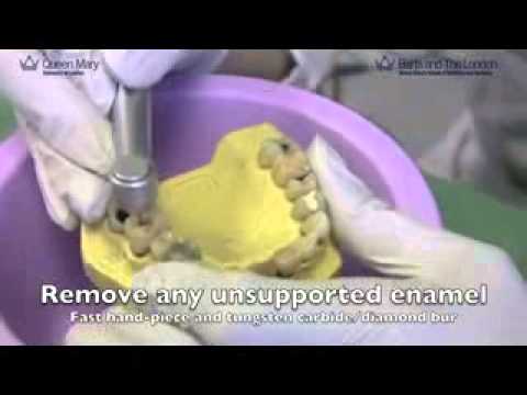 Amalgam Restoration - Occlusal Surface