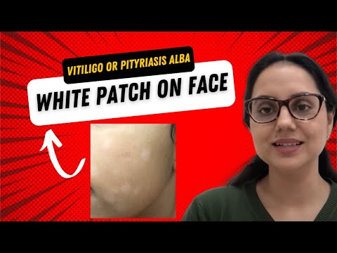 White patch on face- Is this Vitiligo or Pityriasis alba? II Dr Surbhi, MD