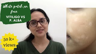 White patch on face- Is this Vitiligo or Pityriasis alba? II Dr Surbhi, MD