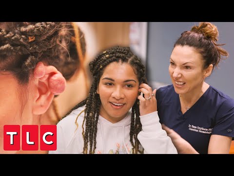 Painful Keloid Cluster on Miya's Ear: Dr. Emma Examines | Save My Skin