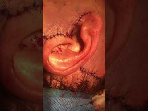 Watch Video: Revision #DeepPlaneFaceLift Scar