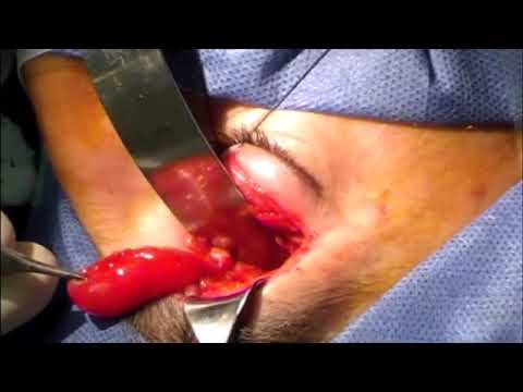 Schwannoma supraorbitario