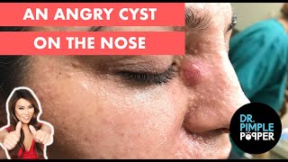 An Angry Cyst on the Nose