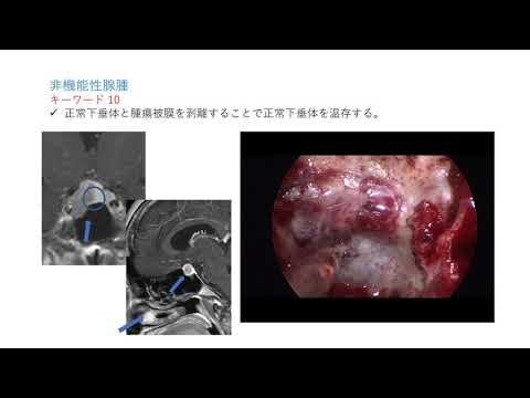 下垂体腫瘍：その正体、症状、原因、治療