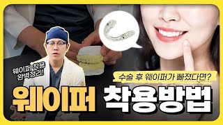 수술 후 웨이퍼가 빠졌다면?