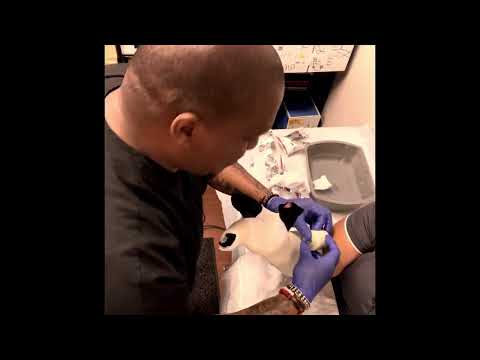 Shoe Arm Ulna Gutter Cast