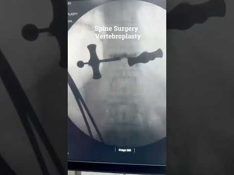 What Is Vertebroplasty? How It’s Done Explained by Dr Ajay Kothari | Sancheti Hospital