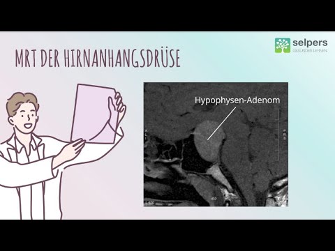 Akromegalie Diagnose erklärt – Welche Untersuchungen gibt es?