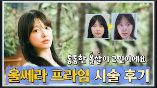 통통한 볼살이 고민이신 분 주목!!  울쎄라프라임 시술후기