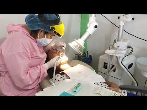 root canal second session