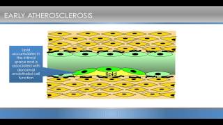 Atherosclerosis - Part 2 - The plot thickens