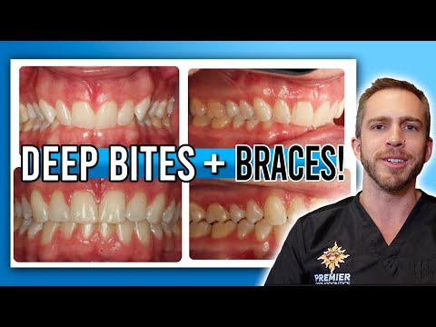 Deep Bite Braces Treatment! [BEFORE & AFTER]