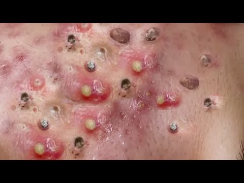 Huge Acne Relaxing