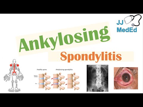 Az SPA – spondylitis ankylopoetica (Bechterew-kór) Széles szalag a betegség