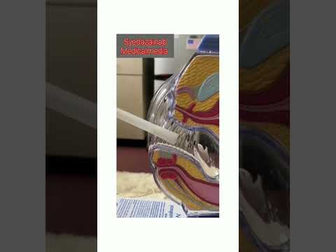 how to insert vaginal cream.. very effective treatment of vaginitis or any fungal infection.