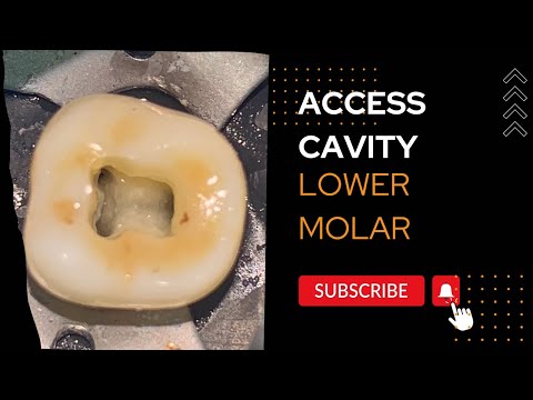 Calcified Lower Molar Access Opening