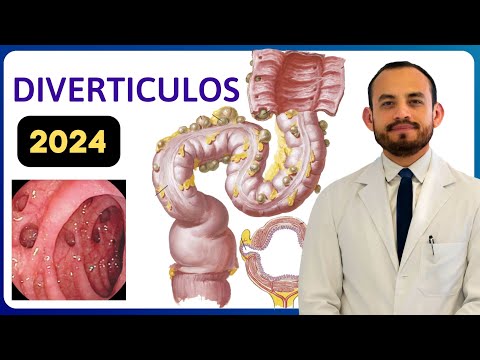 🔴 Qué son los 𝐃𝐢𝐯𝐞𝐫𝐭𝐢́𝐜𝐮𝐥𝐨𝐬 𝐝𝐞𝐥 𝐂𝐨𝐥𝐨𝐧? (Para Médicos)