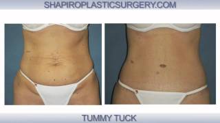 Shapiro Plastic Surgery
