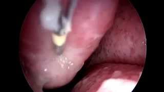 Cirugía de Cornetes mediante endoscopia y Radiofrecuencia