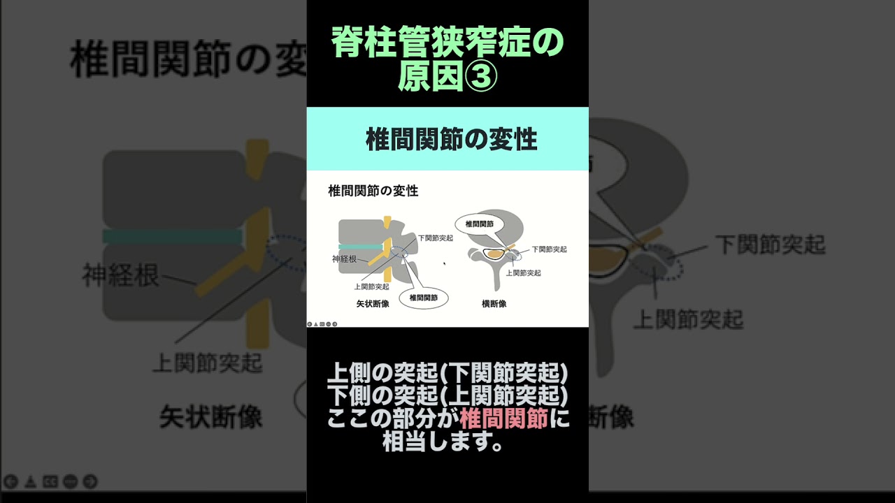 椎間関節の変性(脊柱管狭窄症とその原因③)【頸椎MRI/腰椎MRI画像診断のコツ】#shorts