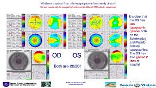 Download Lagu Initial Outcomes with Customized Myopic LASIK, Guided by Automated Ray Tracing Optimization Thumbnail
