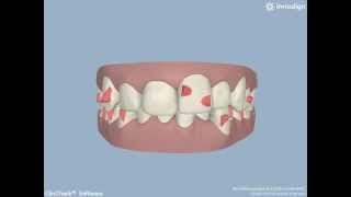 preview picture of video 'Invisalign Dentist in Tigard OR'