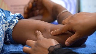 Removing Contraceptive Implants (Health Workers) -