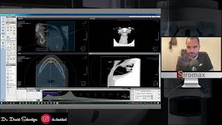 Xelis Dental Paso a Paso Parte 2: Análisis vía aérea, Segmentación y STL Export