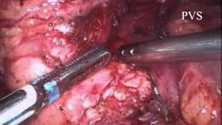 Laparoscopic Whipples pancreatoduodenectomy for pancreatic cancer