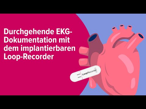 Durchgehende EKG-Dokumentation mit dem implantierbaren Loop-Recorder