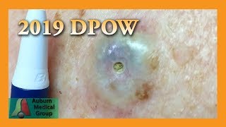 2019 Dilated Pore of Winer | Auburn Medical Group
