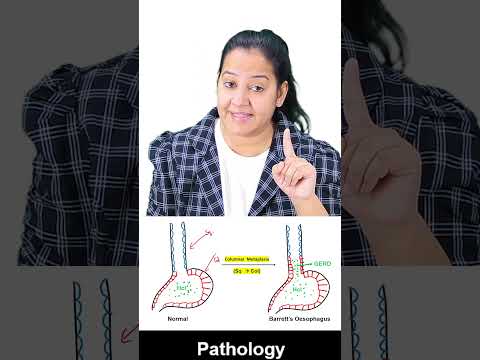 1 minute learning:    Barrett’s Oesophagus