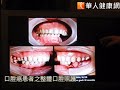 整體口腔重建　幫助口腔癌友恢復咀嚼