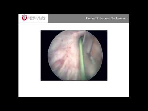 Background About Urethral Strictures