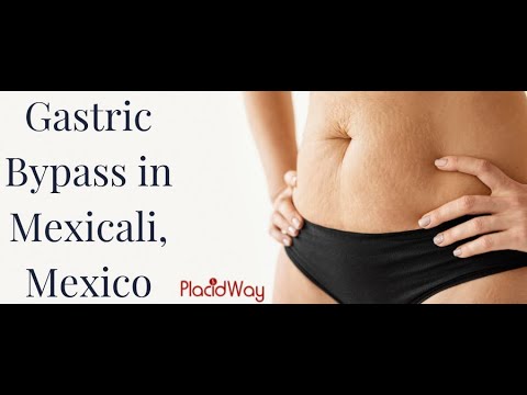 Watch Gastric Bypass in Mexicali, Mexico