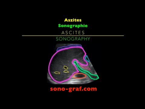 Sonographie - Aszites