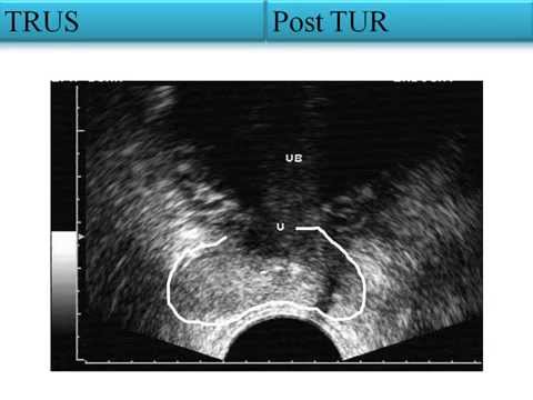 Prostata-Massage in Perovo Behandlung von Prostatitis Fanfare