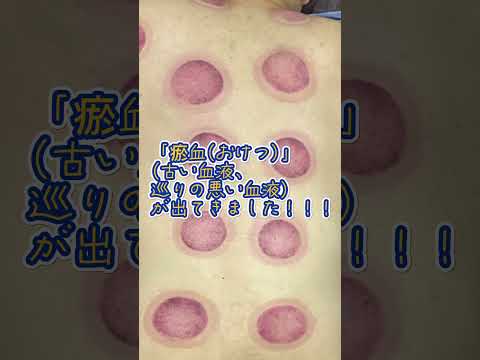 医学科 吸い玉のすすめ