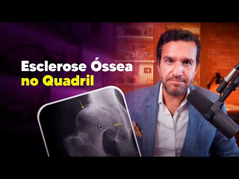 Esclerose óssea no quadril, o que é isso? - Dr. David Gusmão