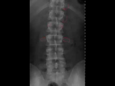 Lumbar Spine Radiology Tutorial