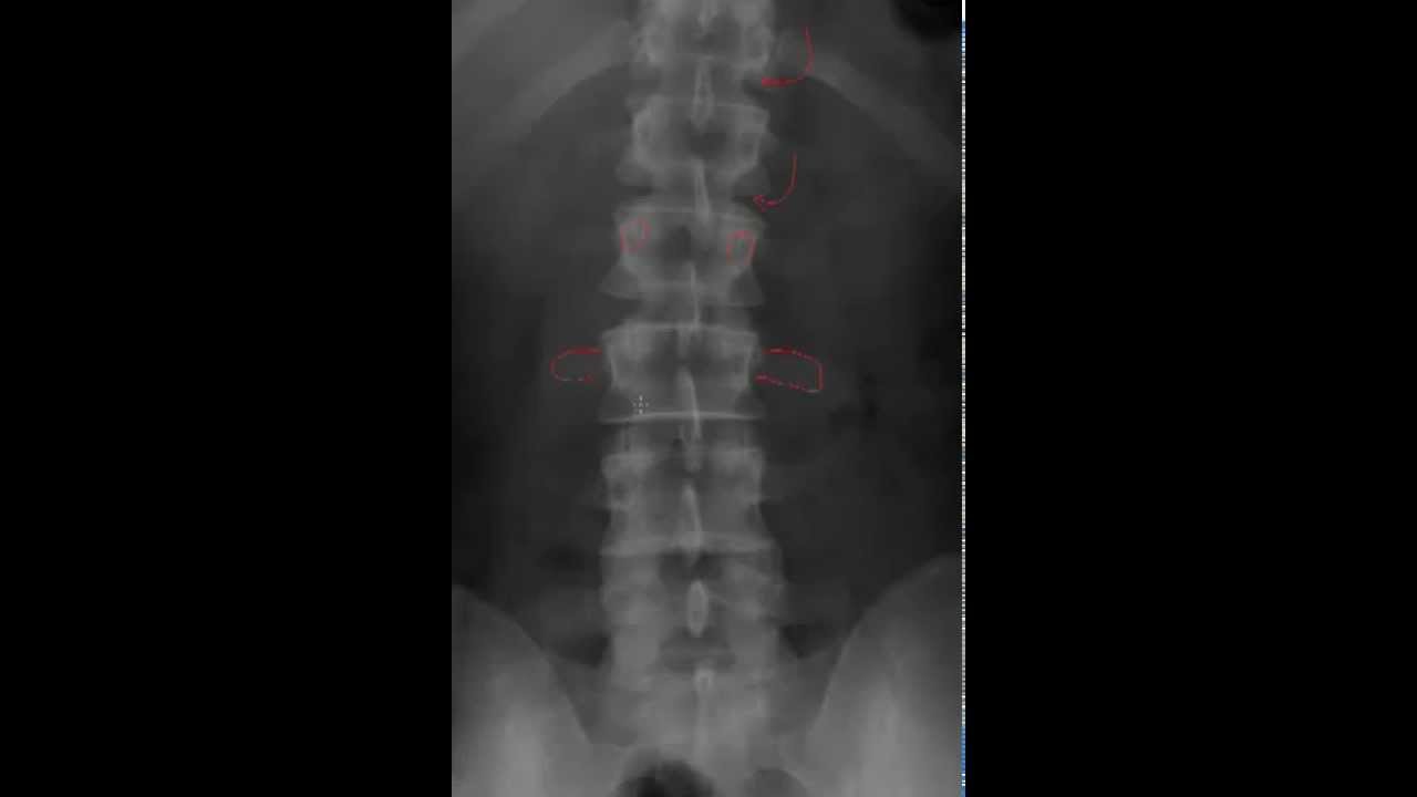 Lumbar Spine Radiology Tutorial