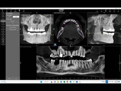 Extrapolating a Pan from CBCT in Acteon AIS software