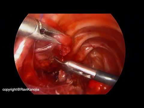 Cure thoracoscopique de l'atrésie de l'œsophage