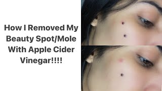 HOW I REMOVED MY BEAUTY SPOT/MOLE AT HOME WITH APPLE CIDER VINEGAR!!! Videos included!!!!