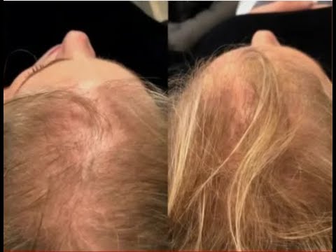 Platelet Rich Plasma (PRP) - Hair Growth - Ajax, Ontario