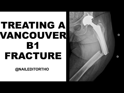 Treating a Vancouver B1 Periprosthetic Fracture